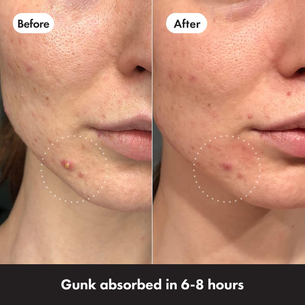 Hero Mighty Patch Day & Night, Hydrocolloid Pimple Patches (24 Pack)