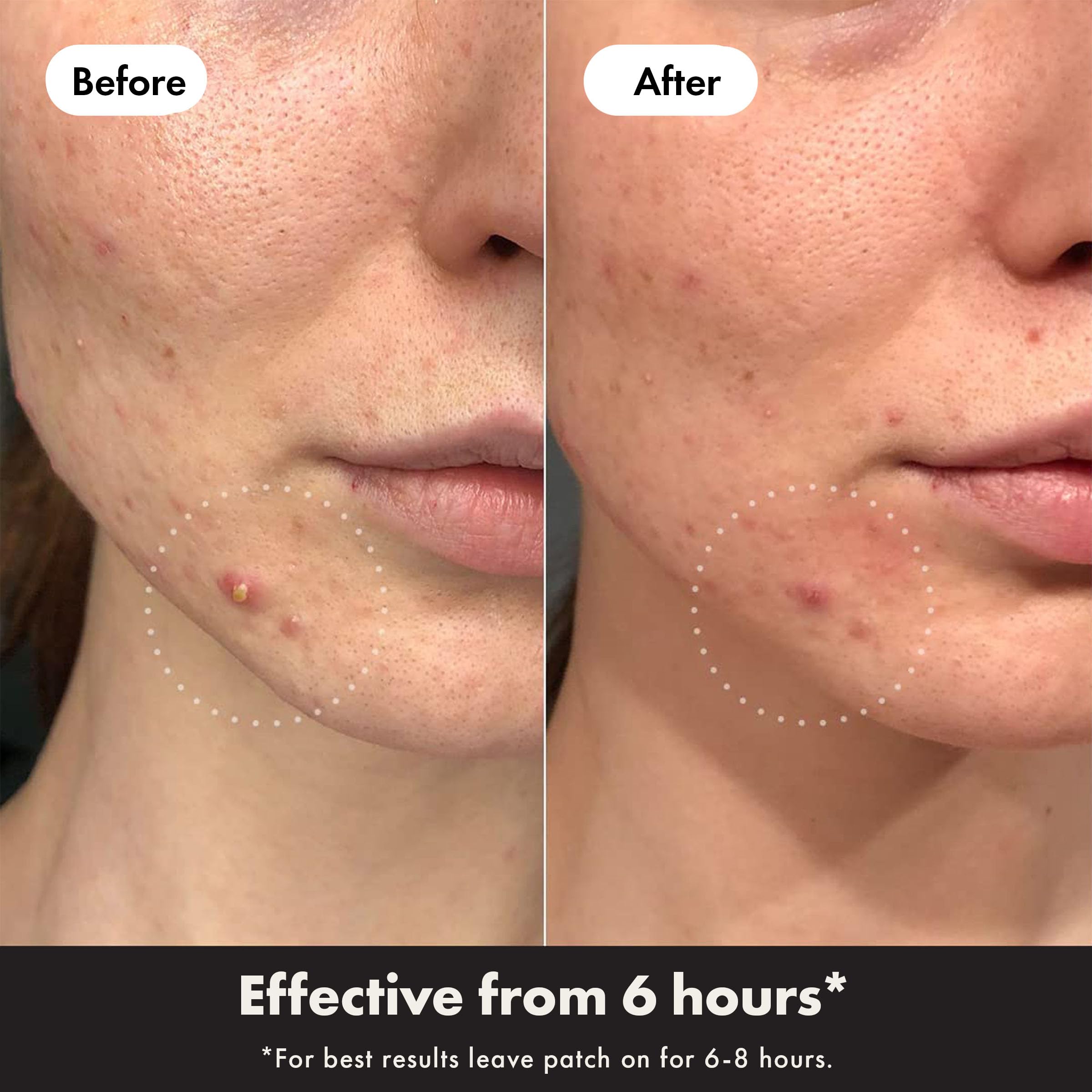 Hero Mighty Patch Day & Night, Hydrocolloid Pimple Patches (24 Pack)